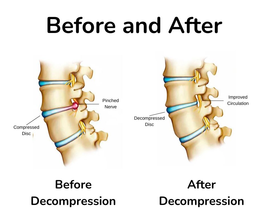 spine before and after spinal compression for chronic neck pain
