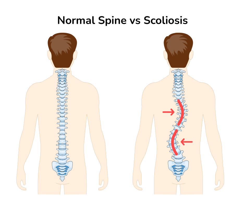 diagram showing a healthy spin and a spine with scoliosis tucson chiropractor