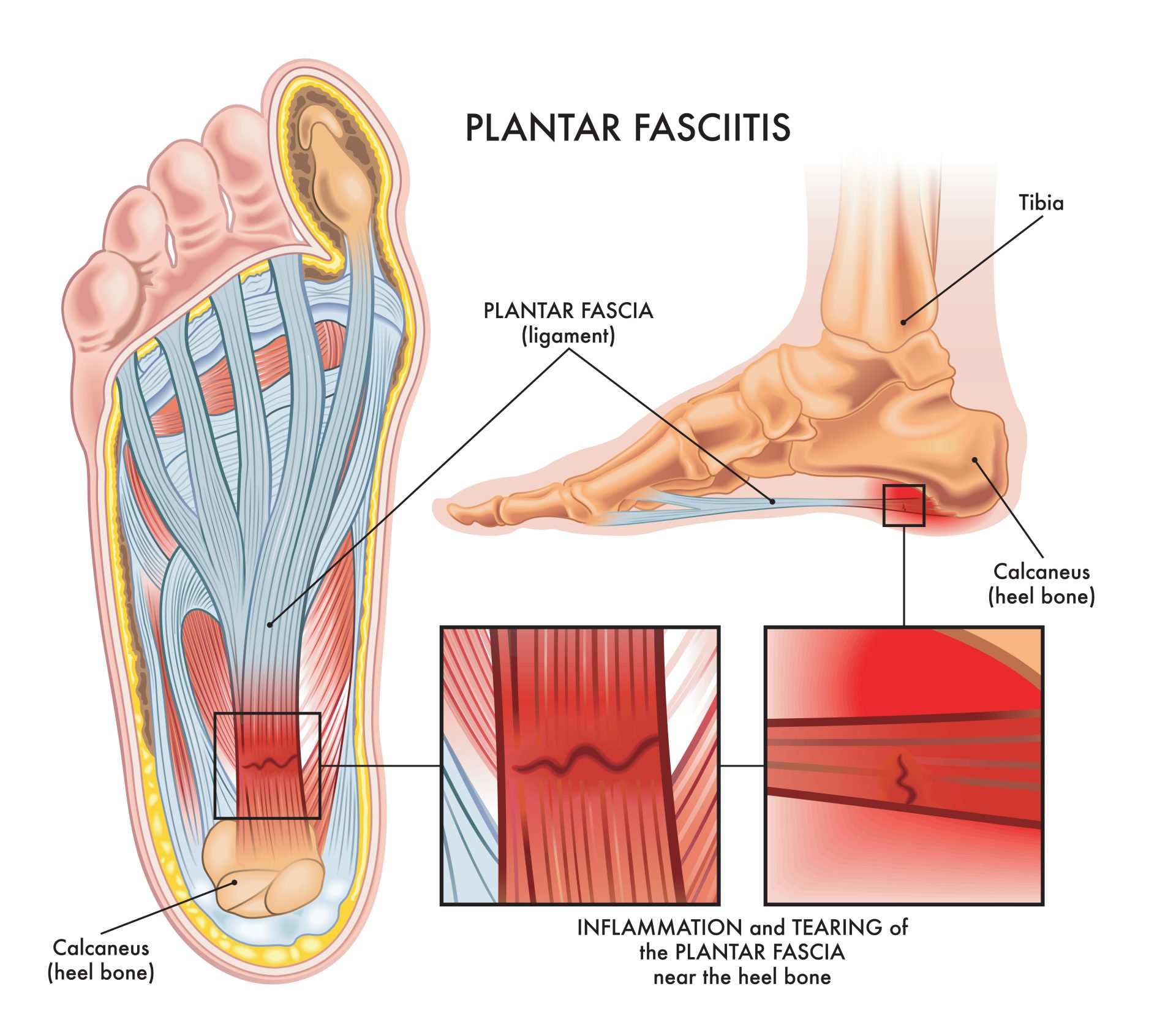 Plantar fasciitis diagram showing plantar fascia inflammation and tearing near heel bone.