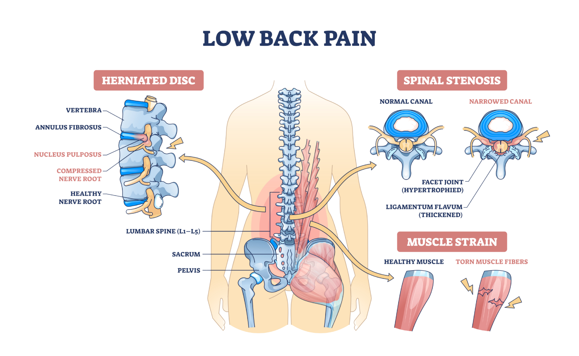 low back pain infographic