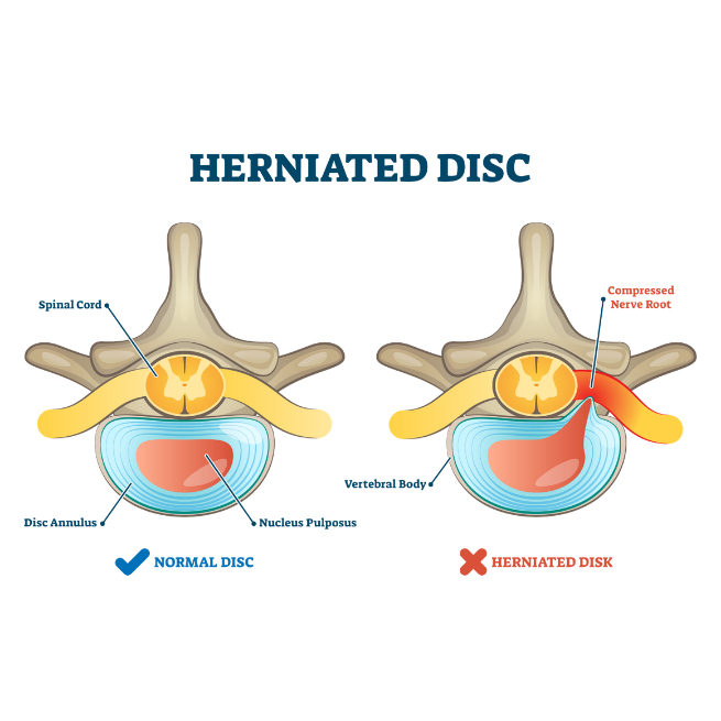 what a herniated disc is infographic
